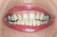Before Photo Smile Line Dentistry in Bayside NY Queens