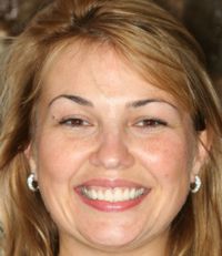 Before Photo Smile Line Dentistry in Bayside NY Queens