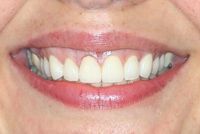 Before Photo Smile Line Dentistry in Bayside NY Queens