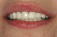 Photo Smile Line Veneer Temporaries Dentistry in Bayside NY Queens