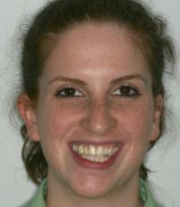 Bad Bridge Porcelain Replacement Dentistry Bayside NY