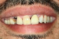 Porcelain Crowns gone Bad Replacement Dentistry Bayside NY