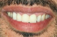 Failed Crowns Bayside Replacement Photo