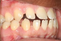Flared Teeth Bite Occlusion Distortion