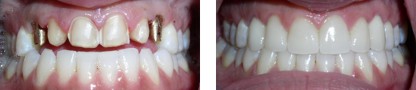 Before and After Dental Implant Pictures Bayside Queens