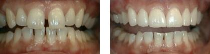 Porcelain Veneer Diastema Treatment Bayside Queens