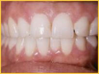 Successful Melanin Removal Pink Gum Laser Treatments Bayside Pictures