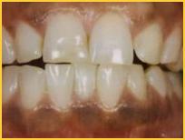 Black Gum Laser Treatments Bayside Pictures