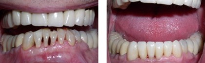 Perio Disease Treatment Bayside Queens