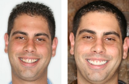 Porcelain 10 Veneer Treatment Bayside Queens