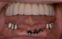 Mandibular Dental Implants Combination Technologies Bayside