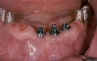 Close up picture Implants Abutments Lower Jaw