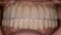 Close up picture Implants installed Lower Jawbone