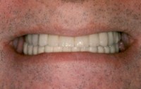Final Bayside Cosmetic Result Implants installed Jawbone