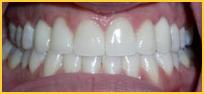 Before and After Implant Photos in Bayside NY