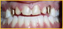 Before and After Implant Photos in Bayside NY