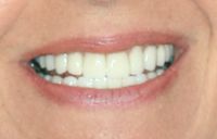 Instant Orthodontics No Braces Straight Teeth Dentistry