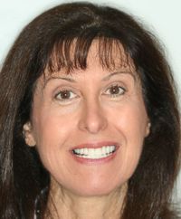 Instant Orthodontics Straight Teeth No Metal Braces