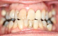 Instant Orthodontics No Braces Straight Teeth Dentistry