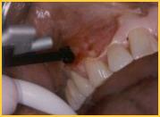 Laser Demonstration Melanin Removal Pigmentation