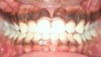 Close up picture Dark Gingival Excess Pigmentation