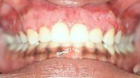 Close up picture Dark Gingival Excess Pigmentation