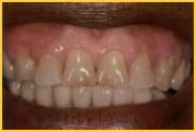 Healing Gum Tissue after Laser Pigmentation Removed