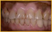 Close up picture Dark Gingival Excess Pigmentation