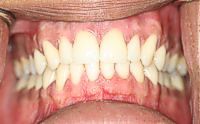 New Pink Gums with New Porcelain Veneers Pictures