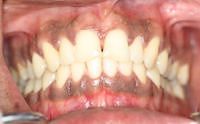 Male  Dark Gingival Excess Pigmentation Pictures