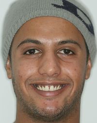 Male  Dark Gingival Excess Pigmentation