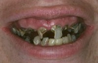 Extreme Long Term Acidity Austin