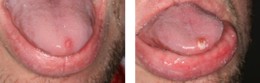 Canker Sore Oral Herpes Lesion Removal Bayside