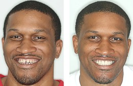 Anterior Tooth Enamel Replacement 
