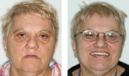 Implant Prosthodontist Treatment Bayside Queens