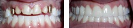 Dental Implant Pictures Bayside Queens
