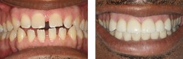 Broken Teeth Diastema Repair Long Island Queens