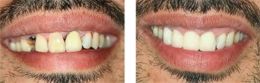 Fix Replace Bad Crowns Veneers Bayside Queens NY
