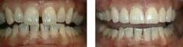 Porcelain Veneer Diastema Treatment Bayside Queens