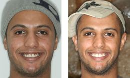 Male Patient Pink Gums Laser Bayside Queens Pictures