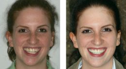 Bad Metal Bridge Replacement Porcelain Bayside NY