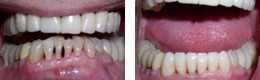 Receding Gums Perio Treatment Bayside Queens