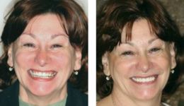 Old Worn Out Crowns Replacement Dentistry Bayside NY