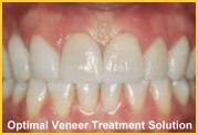 Porcelain Veneer Best Treatment Tetracycline Damage