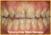 Tetracycline Severe Teeth Stains Best Veneer Application
