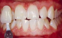Bayside BriteSmile Zoom Whitening Before Pic
