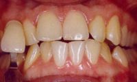 Bayside BriteSmile Zoom Whitening Before Pic